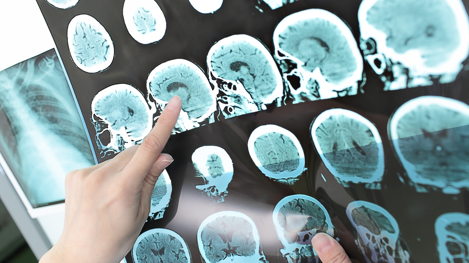 Alkol gelişmekte olan beyne zarar veriyor!