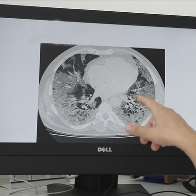 Çocuklarda ve yaşlılarda sık görülüyor, ölüme yol açabiliyor