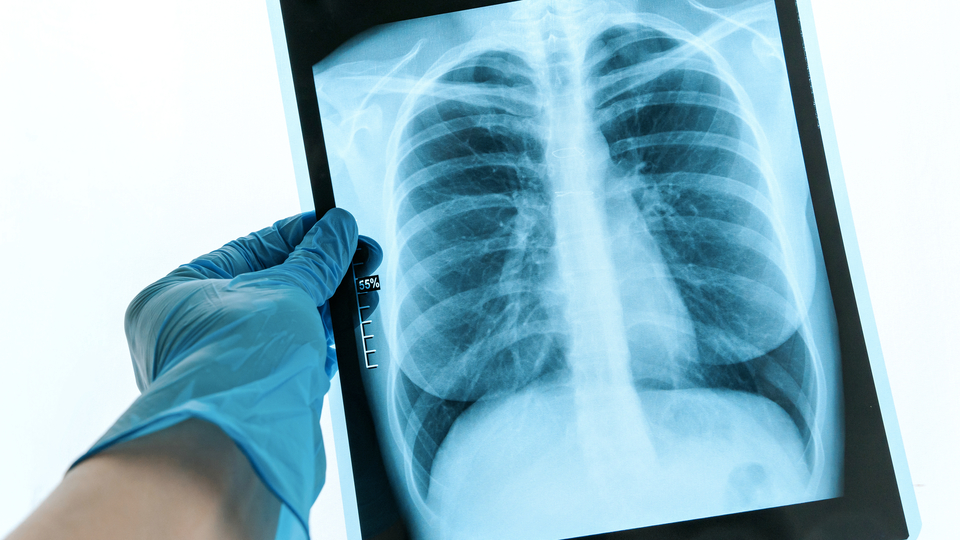 Akciğer kanserinin en büyük nedeni!