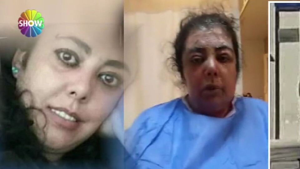 Kardeşinin üstüne kaynar su döktü