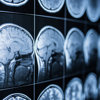 Covid ile beyin arasındaki ilişki platonik!