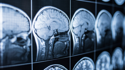 Covid ile beyin arasındaki ilişki platonik!