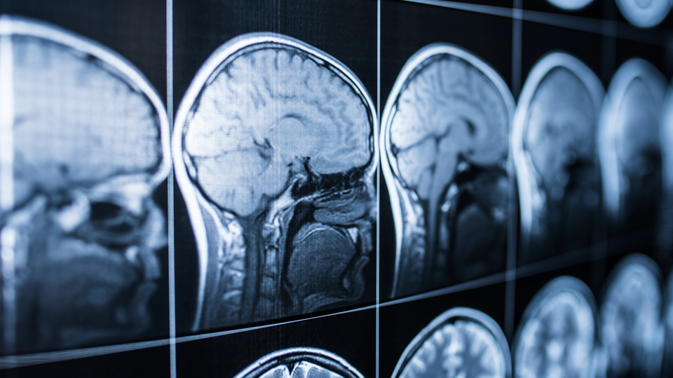 Covid ile beyin arasındaki ilişki platonik!