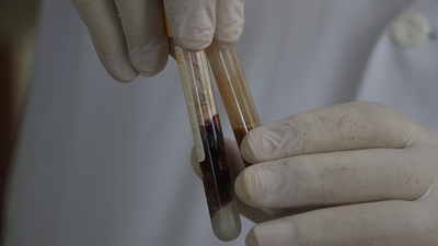 Pekmez toprağından ilham alan doktorlar kanamayı durduran ilaç geliştirdi