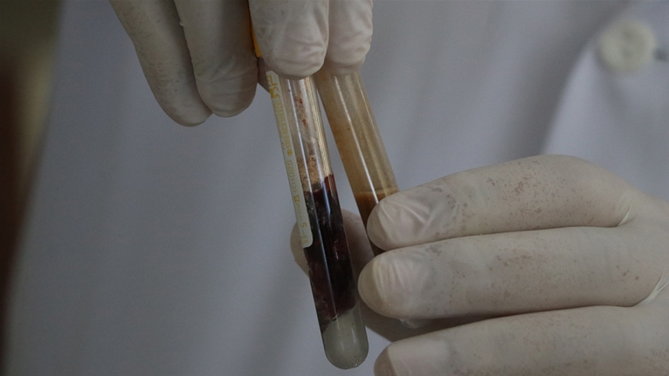 Pekmez toprağından ilham alan doktorlar kanamayı durduran ilaç geliştirdi