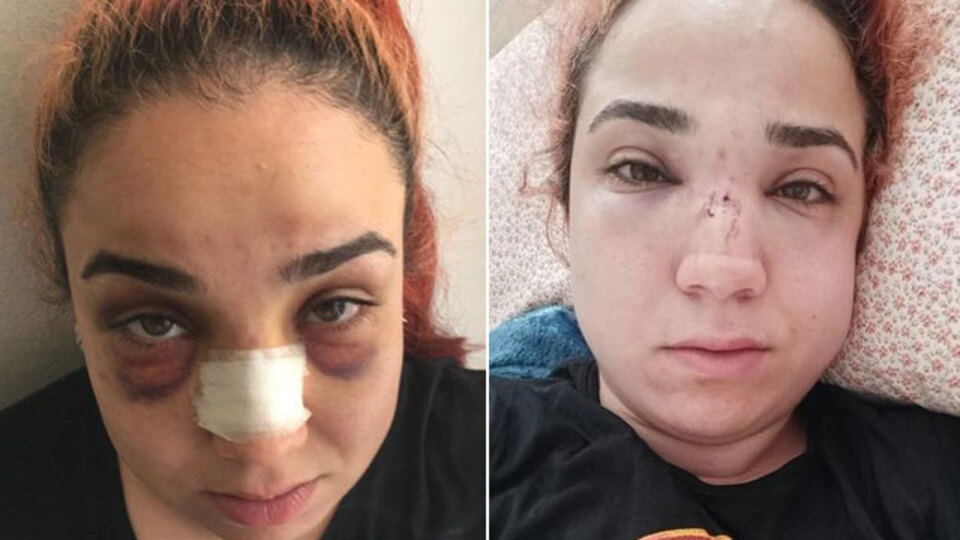 Patron burnunu kırdı! İşçiye de hapis!