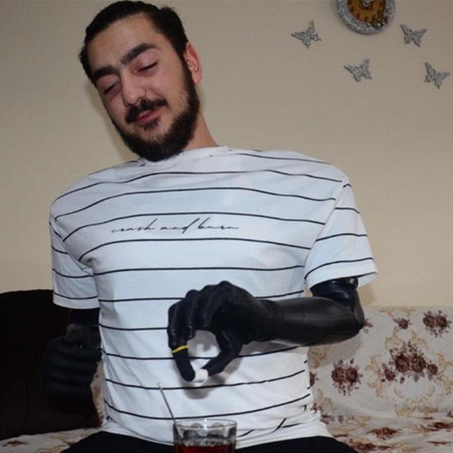 Aydınlı 18 yaşındaki Samet 'biyonik' kollarına kavuştu