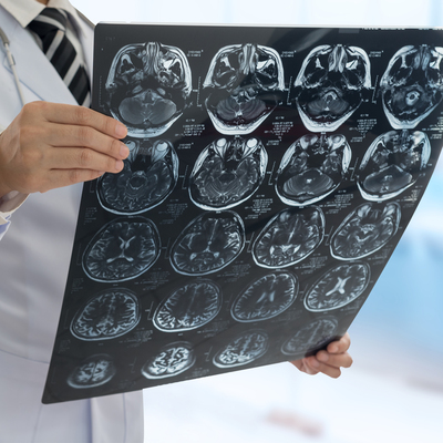 Nörolog bulamayabiliriz! O anketten korkutan sonuç