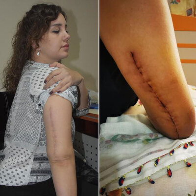 Sevgilisi kolunu kıvırarak kırdı! İki platin takıldı! İşte ceza!