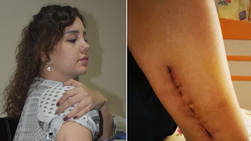 Sevgilisi kolunu kıvırarak kırdı! İki platin takıldı! İşte ceza!