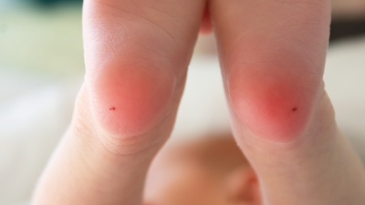 PKU'da etkin tedaviyi almamak beyin hasarına neden oluyor!