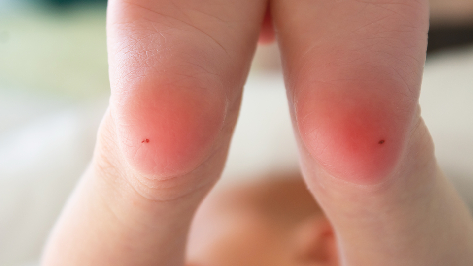 PKU'da etkin tedaviyi almamak beyin hasarına neden oluyor!