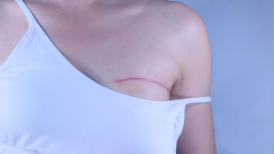 Mastektomi kimlere yapılır?