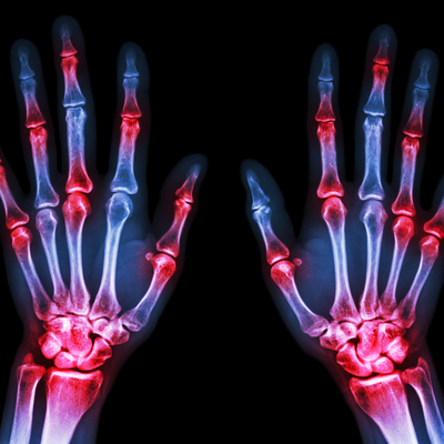 RA: Bağışıklık sisteminin kendi dokularına saldırdığı hastalık!