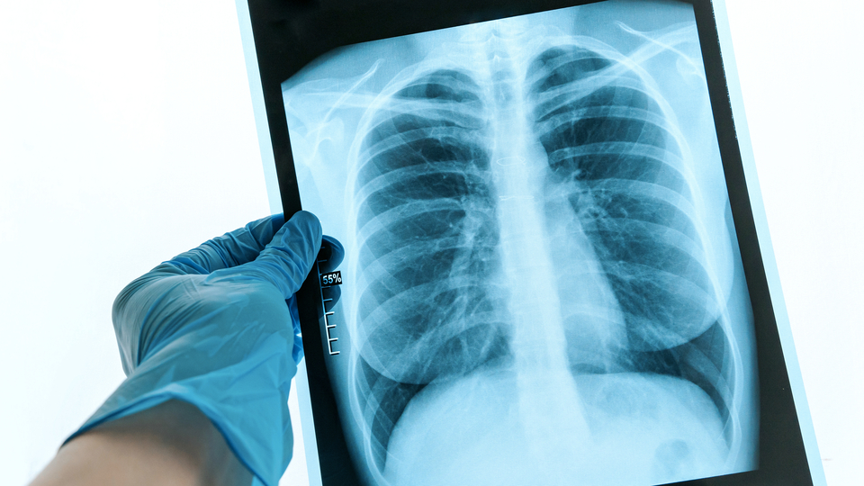 Türkiye'de akciğer kanserinde dünya ortalamasının üzerinde