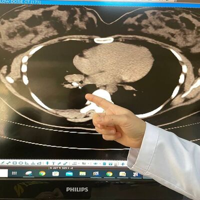 Kanser sanılıyordu! Soluk borusundan badem kabuğu çıktı