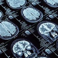 Covid-19 beyni ciddi bir şekilde etkiliyor mu?