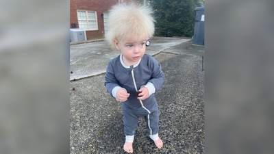 Dünyada 100 kişide görülüyor!