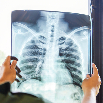 Pandemi sonrası artabilir! Tüberkülozun 6 belirtisine dikkat!