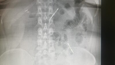 Şoke eden olay! Midesinde 2 tane neşter tespit edildi