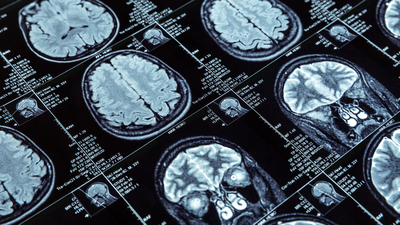 Covid'i ağır geçirenlere önemli uyarı!