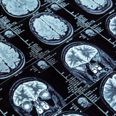 Covid'i ağır geçirenlere önemli uyarı!