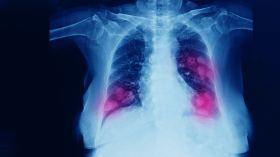 Kanserlerin yaklaşık üçte birinden sorumlu