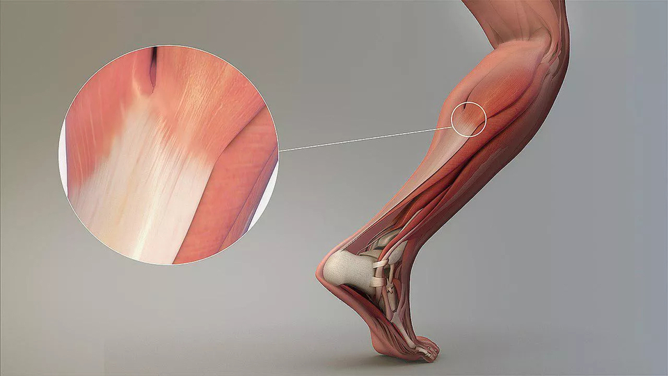 Aşil tendonu kopması nedir?
