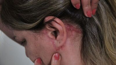 Güzelleşmeye gitti, estetik mağduru oldu