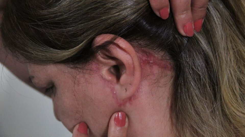 Güzelleşmeye gitti, estetik mağduru oldu