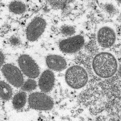 Maymun çiçeği virüsü alarmı! Yayılıyor