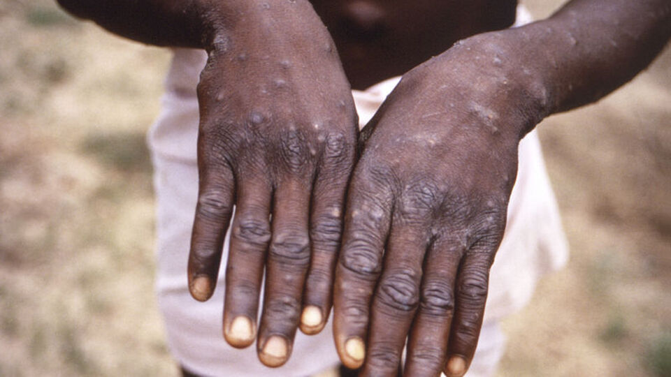 Maymun çiçeği vakaları sonrası ABD ve İngiltere'den aşı hamlesi