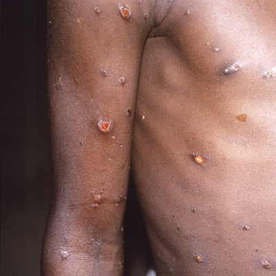 Dünya bu virüsü konuşuyor! Oradan yayıldığı iddia edildi