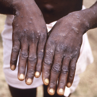 Maymun çiçeği hastalığı! Yeni bir pandeminin eşiğinde miyiz?
