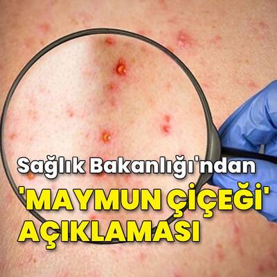 Bakanlık'tan "maymun çiçeği" açıklaması