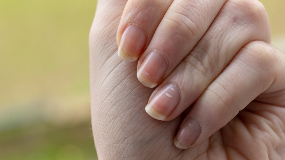 Soluk tırnaklara dikkat!