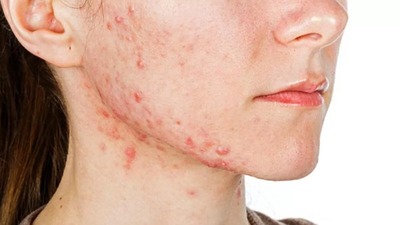 Sivilce deyip geçmeyin!