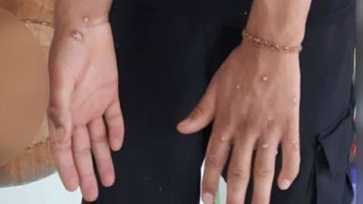 İstanbul'da maymun çiçeği şüphesi