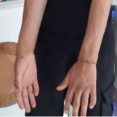 İstanbul'da maymun çiçeği şüphesi