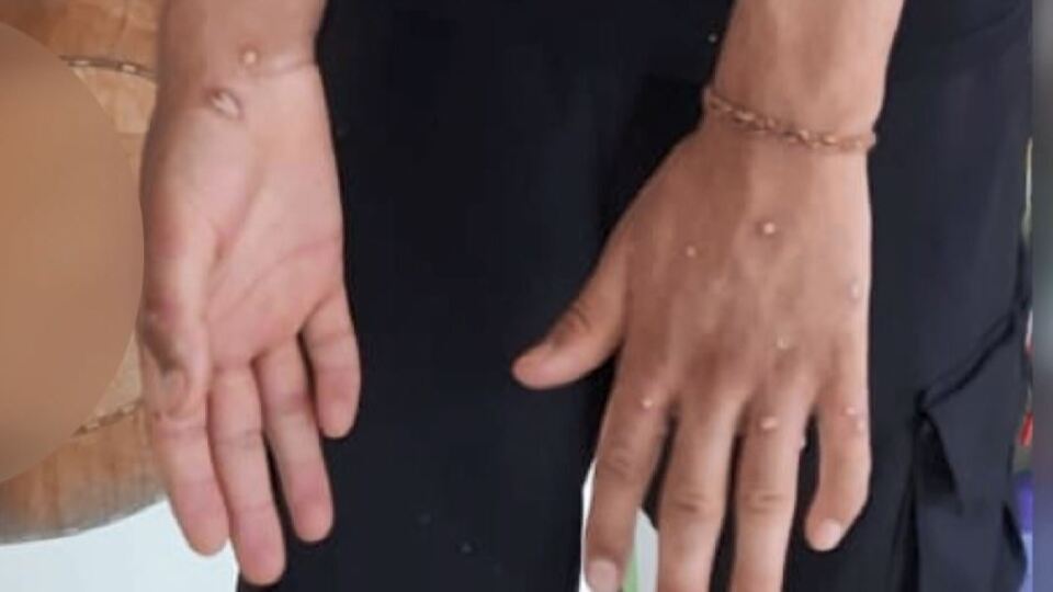 İstanbul'da maymun çiçeği şüphesi