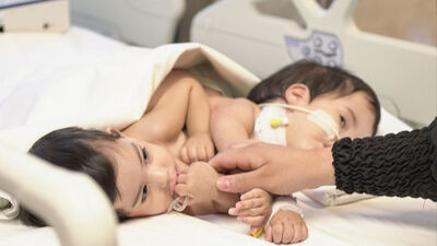 Yapışık ikizler 9 saatlik operasyonla ayrıldı