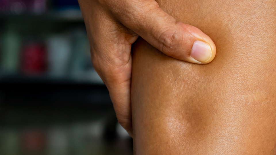 Ödem vücuttan nasıl atılır?