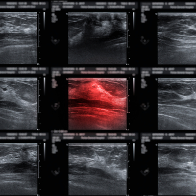 "Meme kanseri neredeyse salgın haline geldi"