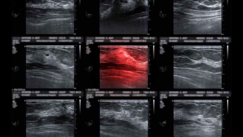 "Meme kanseri neredeyse salgın haline geldi"