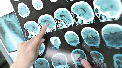 ALS belirtilerine dikkat!