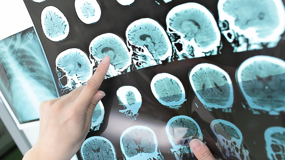 ALS belirtilerine dikkat!