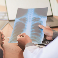 Akciğer kanseri son evre ölüm belirtileri