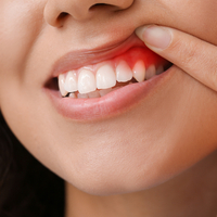 Diş eti iltihabı belirtileri