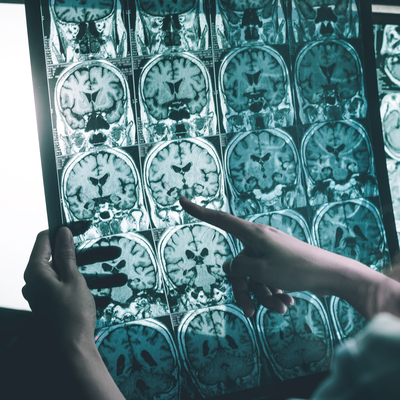 Araştırma ortaya koydu! İşte Alzheimer'ın zor anlaşılan 6 belirtisi