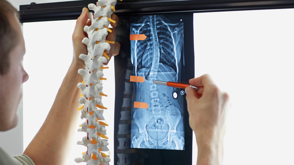 Erişkin skolyoz son yıllarda artıyor!